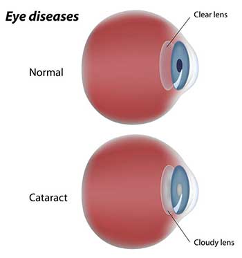 Cataracts Doctor in Reston