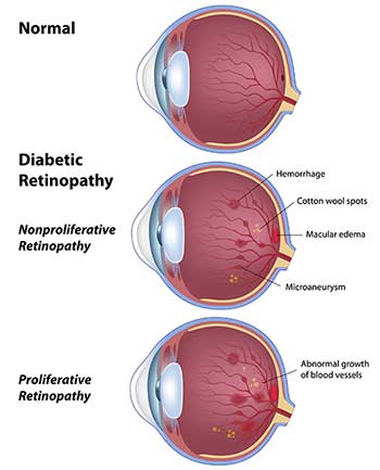 Diabetic Eye Care in Reston