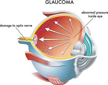 Glaucoma Doctor in Reston
