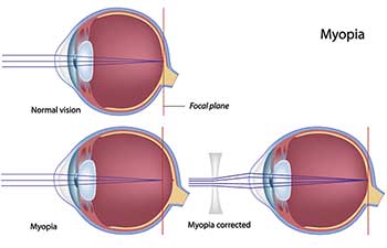 Nearsightedness Treatment in Reston