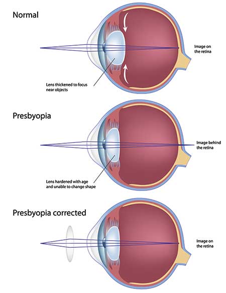 Presbyopia Treatment in Reston